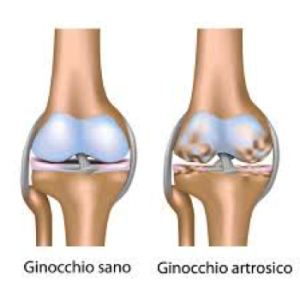 artrosi di ginocchio