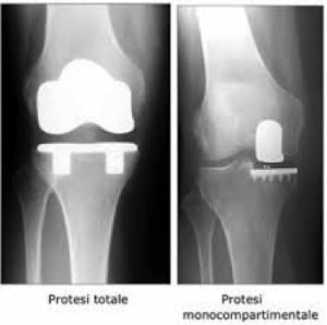 protesi di ginocchio