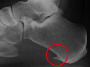 sperone calcaneare